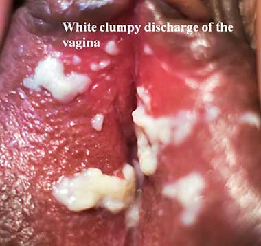 White-clumpy-discharge-of-the-vagina
